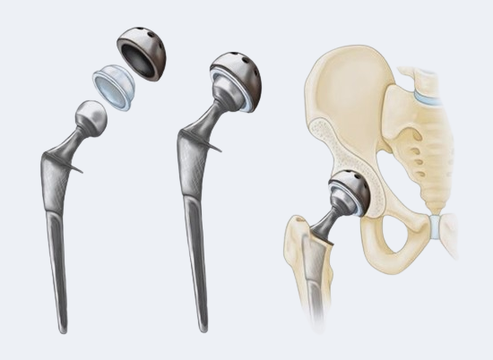 Hip Replacement Surgery