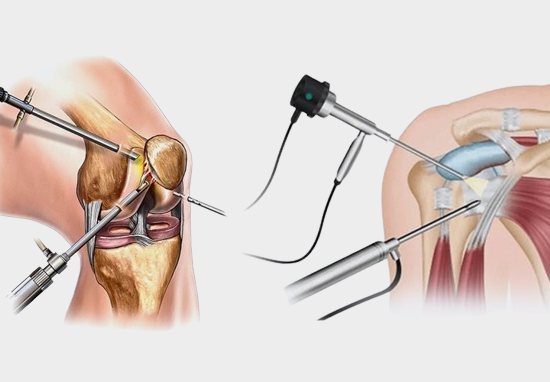 Knee and Shoulder Arthroscopy