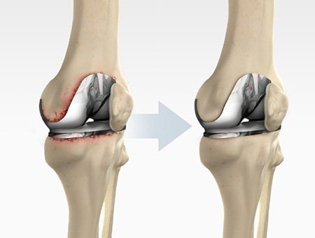 Revision Knee and Hip Replacement Surgery