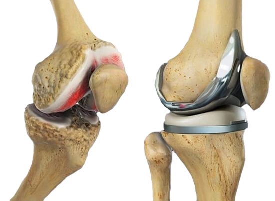 Knee Replacement Surgery