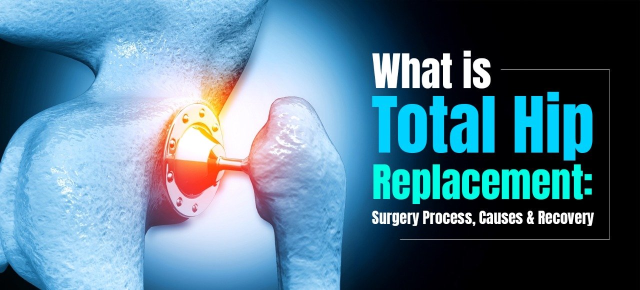 What is Total Hip Replacement: Surgery Process, Causes & Recovery